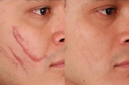 درمان اسکار با لیزر الکساندریت در کلینیک تهران اسکین 