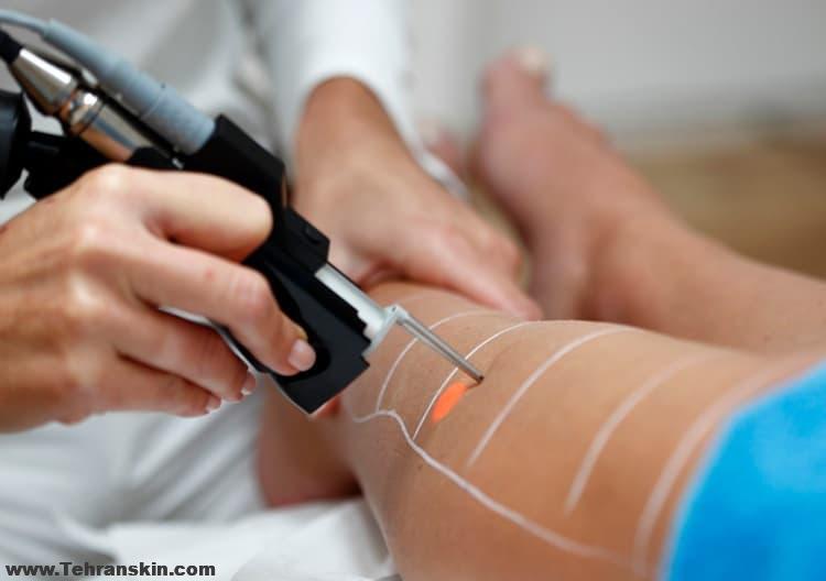 عوارض جانبی جدی لیزر موهای زائد که کمتر اتفاق می افتد!