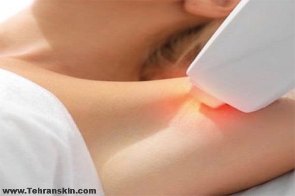 نکاتی در مورد لیزر موهای زائد که باید بدانید اما پزشکان به شما نمی گویند!