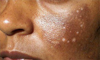 عوارض جانبی جدی تر که کمتر اتفاق می افتد