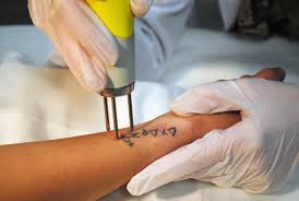 از بین بردن تاتو قدیمی با لیزر الکساندریت