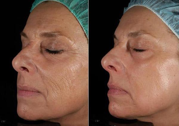 جوان سازی پوست صورت با لیزر الکساندرایت