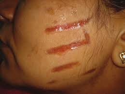 عوارض جانبی جدی لیزر موهای زائد که کمتر اتفاق می افتد!