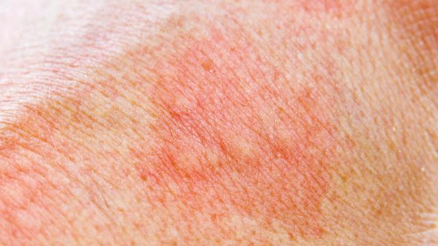 عوارض جانبی لیزر اکساندریت