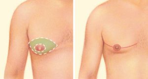 جراحی زیبایی کاهش اندازه سینه در مردان 