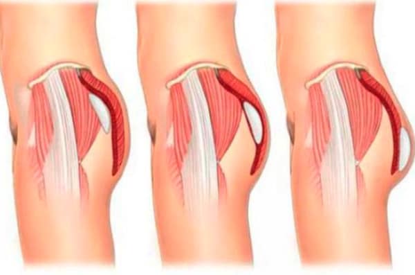 جراحی بزرگ کردن باسن با پروتز | لیفت باسن برزیلی