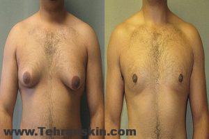  ژنیکوماستی | جراحی کوچک کردن سایز سینه مردان | بهترین جراح ژنیکوماستی