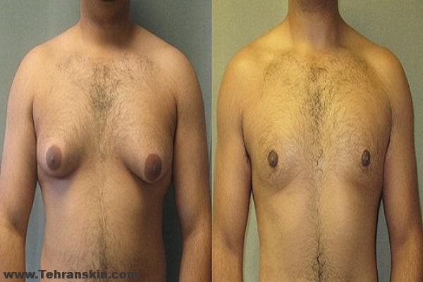 ژنیکوماستی | جراحی کوچک کردن سایز سینه مردان | بهترین جراح ژنیکوماستی