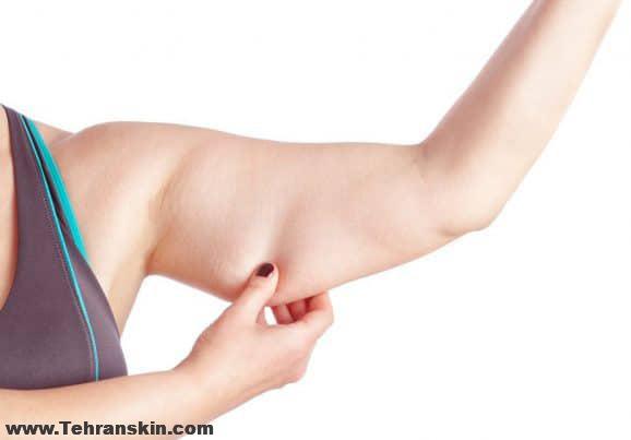 جراحی لیفت بازو برای کسانی که دچار افتادگی بازوها شده اند| براکیوپلاستی