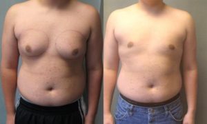 بزرگ شدن پستان پسران در سن بلوغ