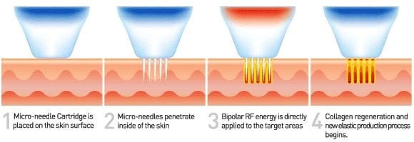 امواج عمودی آر اف میکرونیدلینگ