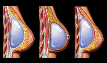 چطوری با پروتز سینه صاحب سینه های خوش فرم و برجسته بشویم؟