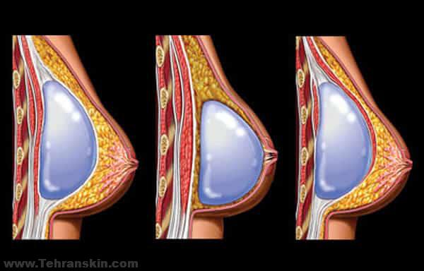 چطوری با پروتز سینه صاحب سینه های خوش فرم و برجسته بشویم؟