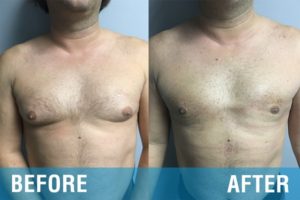 علائم ژنیکوماستی چیست؟