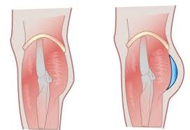 جراحی بزرگ کردن باسن با پروتز | لیفت باسن برزیلی
