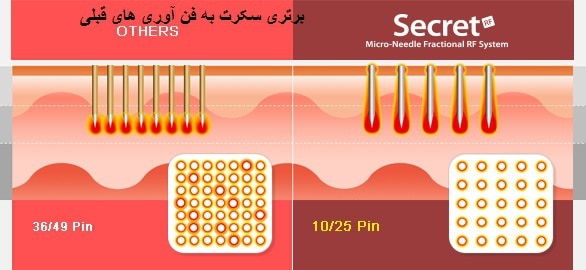 برتری فن آوری سکرت در آراف فرکشنال سوزنی