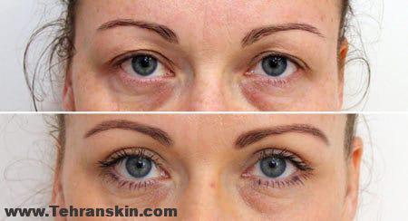 جراحی زیبایی پلک | بلفاروپلاستی | مزایا و عوارض | بهترین دکتر بلفاروپلاستی