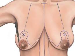 تکنیک های جراحی برای کوچک کردن سینه 