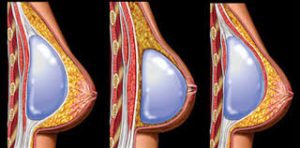 انواع عمل های زیبایی سینه | بزرگ کردن ، کوچک کردن ، لیفت ، بازسازی سینه