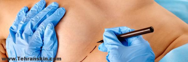 با جراحی لیفت سینه یا مستوپکسی افتادگی سینه خود را توسط متخصص باتجربه درمان کنید