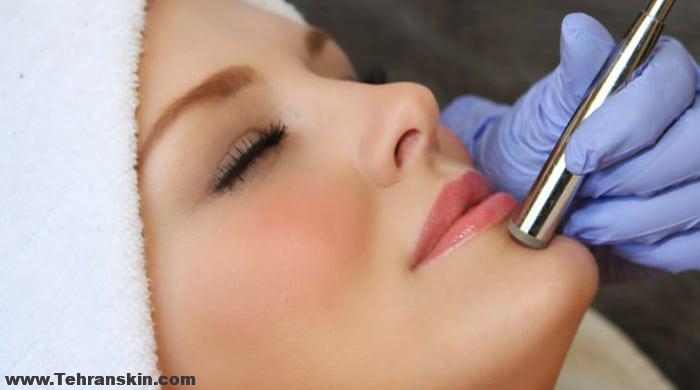 میکرودرم ابریژن برای درمان چین و چروک پوست