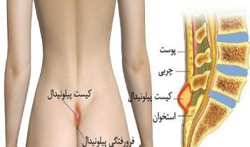 چرا جوانان به کیست مویی یا سینوس پلونیدال مبتلا می شوند | درمان کیست مویی 