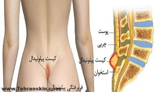 چرا جوانان به کیست مویی یا سینوس پلونیدال مبتلا می شوند | درمان کیست مویی