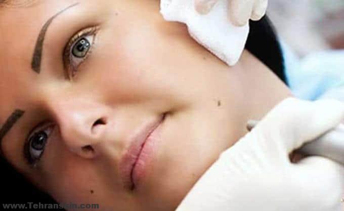 لیزر بدون درد