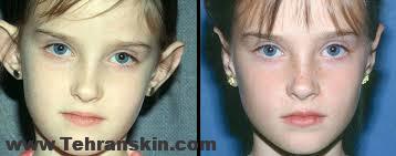 جراحی اتوپلاستی