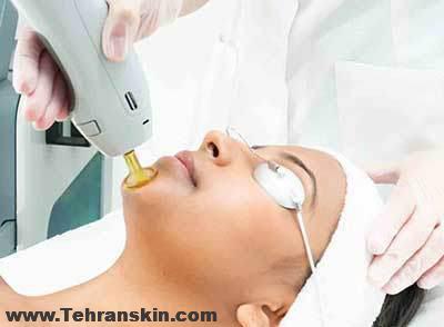 اگر ام اس دارید می توانید لیزر موهای زائد انجام دهید | مرکز لیزر شریعتی