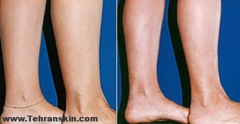 لاغری ساق و مچ پا با جدید ترین روش ها | لیپوست