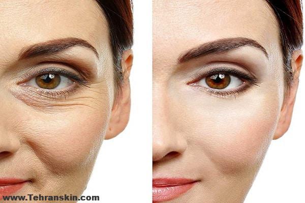 کربوکسی تراپی برای جوانسازی صورت ، تیرگی زیر چشم و رفع سلولیت و لاغری