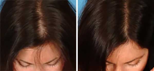 مرکز تخصصی کربوکسی تراپی برای درمان ریزش مو