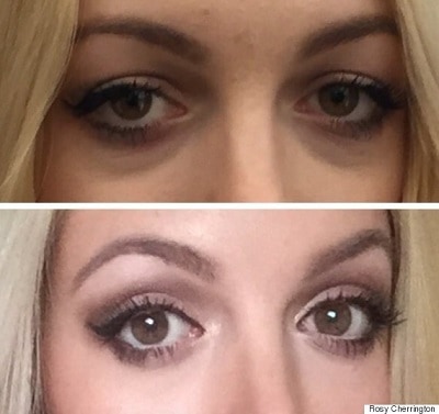 کربوکسی تراپی برای رفع سیاهی زیر چشم