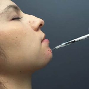 افزایش حجم چانه بدون جراحی
