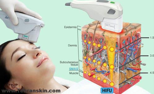 بهترین روش برای جوانسازی پوست چیست | در مرکز لیزر و زیبایی برکه جوان شوید!