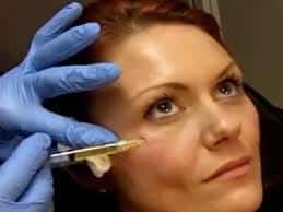 PRP برای درمان جوان سازی و زیبایی تیرگی زیر چشم