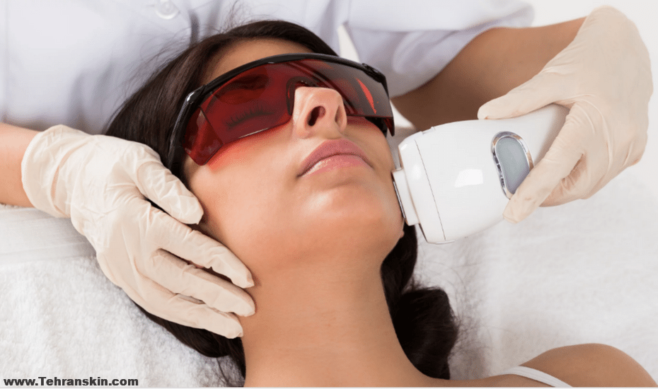 لیزر موهای زائد