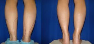 لاغری ساق و مچ پا با جدید ترین روش ها | لیپوست