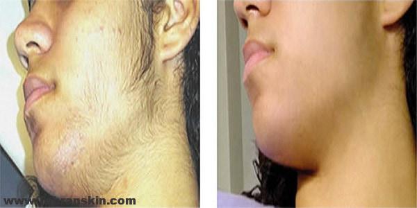 درمان هیرسوتیسم با لیزر لکساندرایت | لیزر موهای زائد | لیزر بدون درد