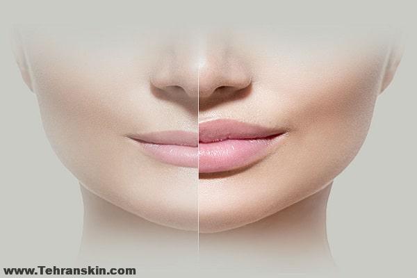 رفع پیری و چروک صورت با فیلرها و پرکننده ها | هزینه تزریق ژل لب و فیلر ها
