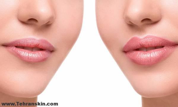 برجسته سازی لب ها با روش تزریق چربی