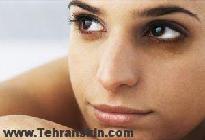 روش های زیبایی برای از بین بردن تیرگی دور چشم و اصلاح گودی چشم در کلینیک زیبایی برکه