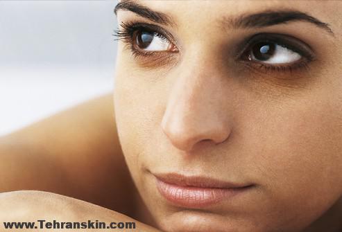 روش های زیبایی برای از بین بردن تیرگی دور چشم و اصلاح گودی چشم در کلینیک زیبایی برکه