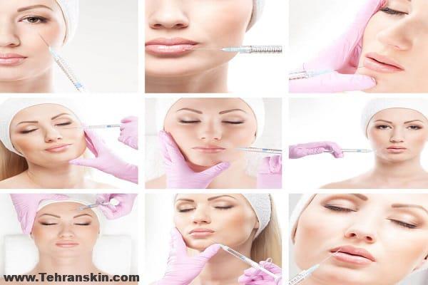 فیلر صورت یا لیفت صورت؟ انواع فیلرها ، مزایا و عوارض ، ماندگاری فیلرها