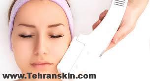 هزینه لیزر موهای زائد صورت