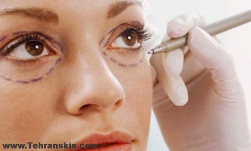 عمل پلک چشم