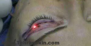 هزینه جراحی پلک بالا