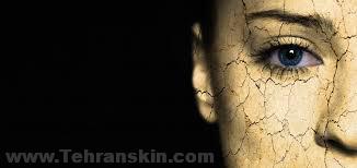 میکرودرم خوبه یا پیلینگ