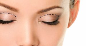 جراحی زیبایی اطراف چشم